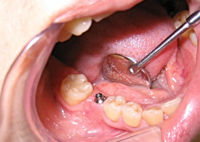 Situation nach ca. 3 Monaten mit Zahnfleischformer
